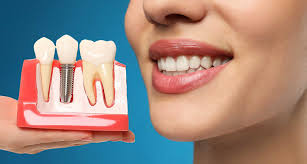 How Can I Tell If My Dental Implant in Dubai Is Healing Properly