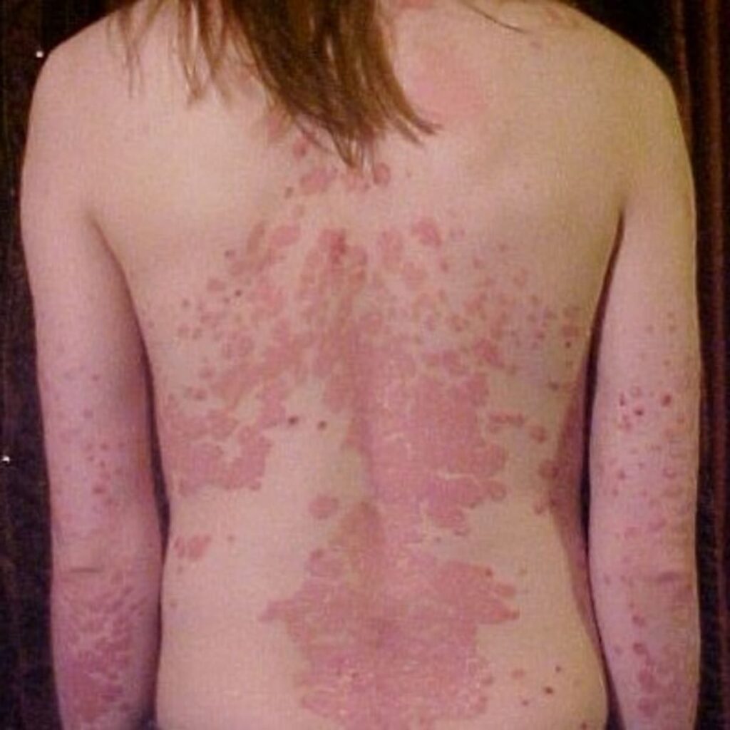 Is Your Persistent Acne Linked to Air Pollution in Dubai