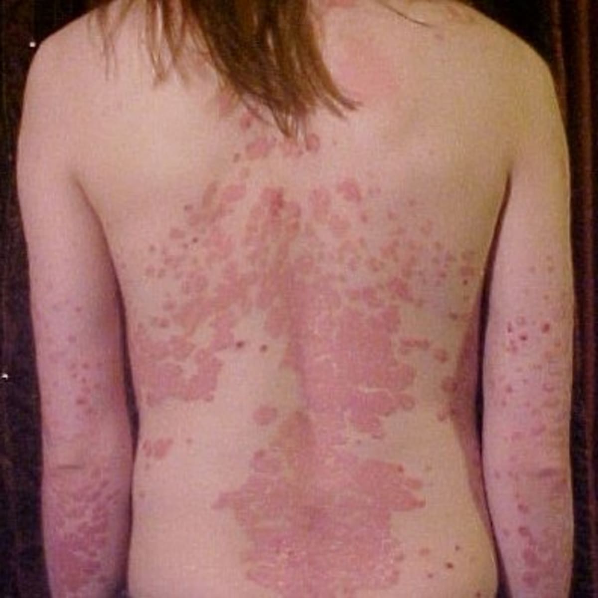 Is Your Persistent Acne Linked to Air Pollution in Dubai