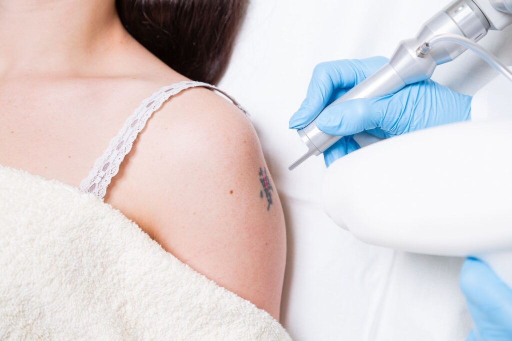 Painless Laser Tattoo Removal in Dubai