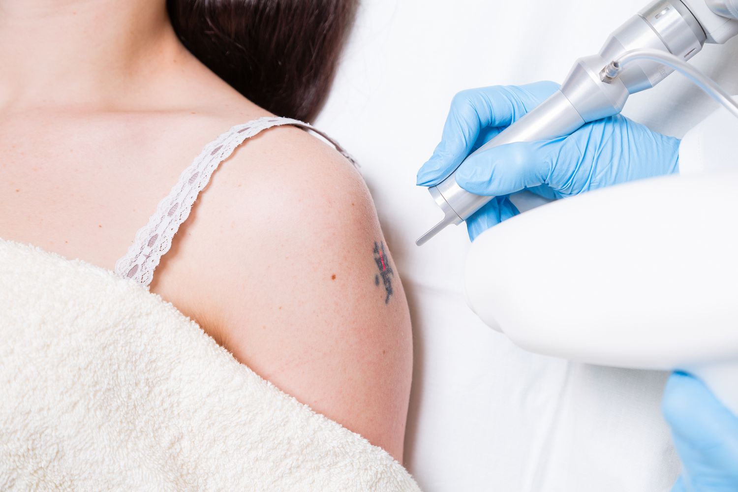 Painless Laser Tattoo Removal in Dubai