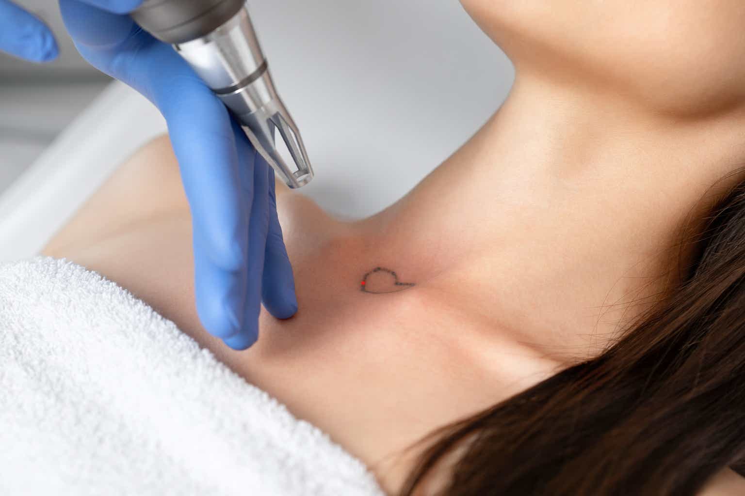Laser Tattoo Removal in Dubai