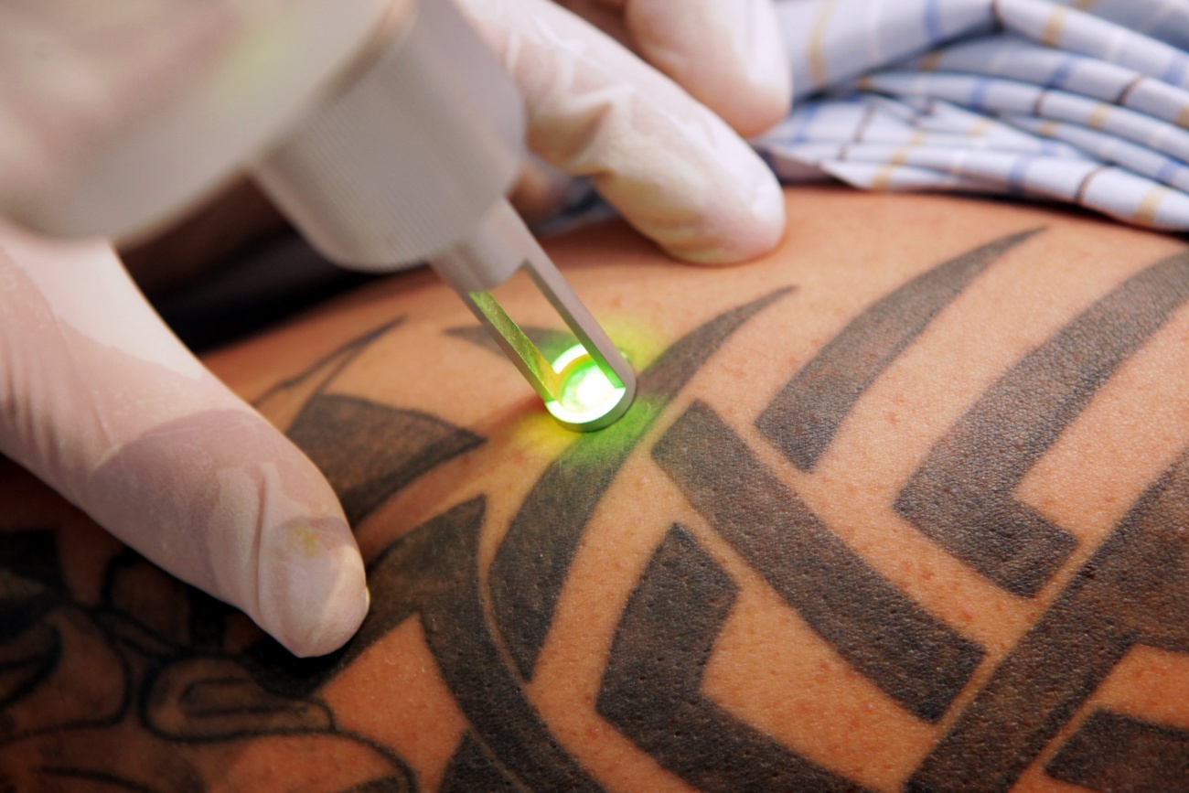 Laser Tattoo Removal in Dubai