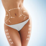 Non-surgical Liposuction In Dubai