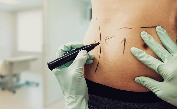 How To Prepare For Liposuction Surgery In Dubai?