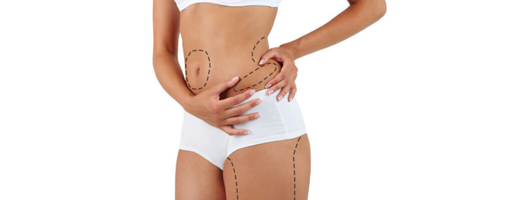 VASER Liposuction in Islamabad: What to Expect