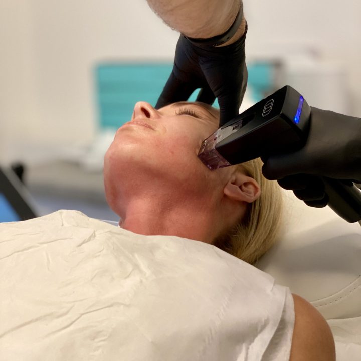 Is the Morpheus 8 Procedure the Safest Facelift?
