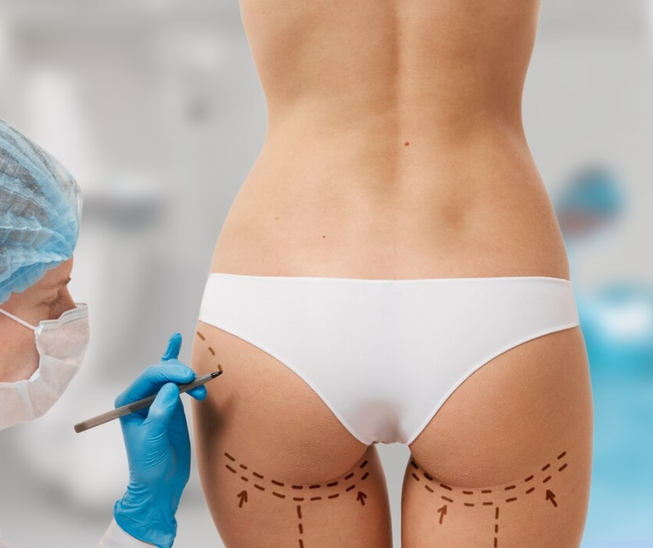 Why Non-Surgical Butt Lifts Are Becoming the Preferred Option Over Surgery