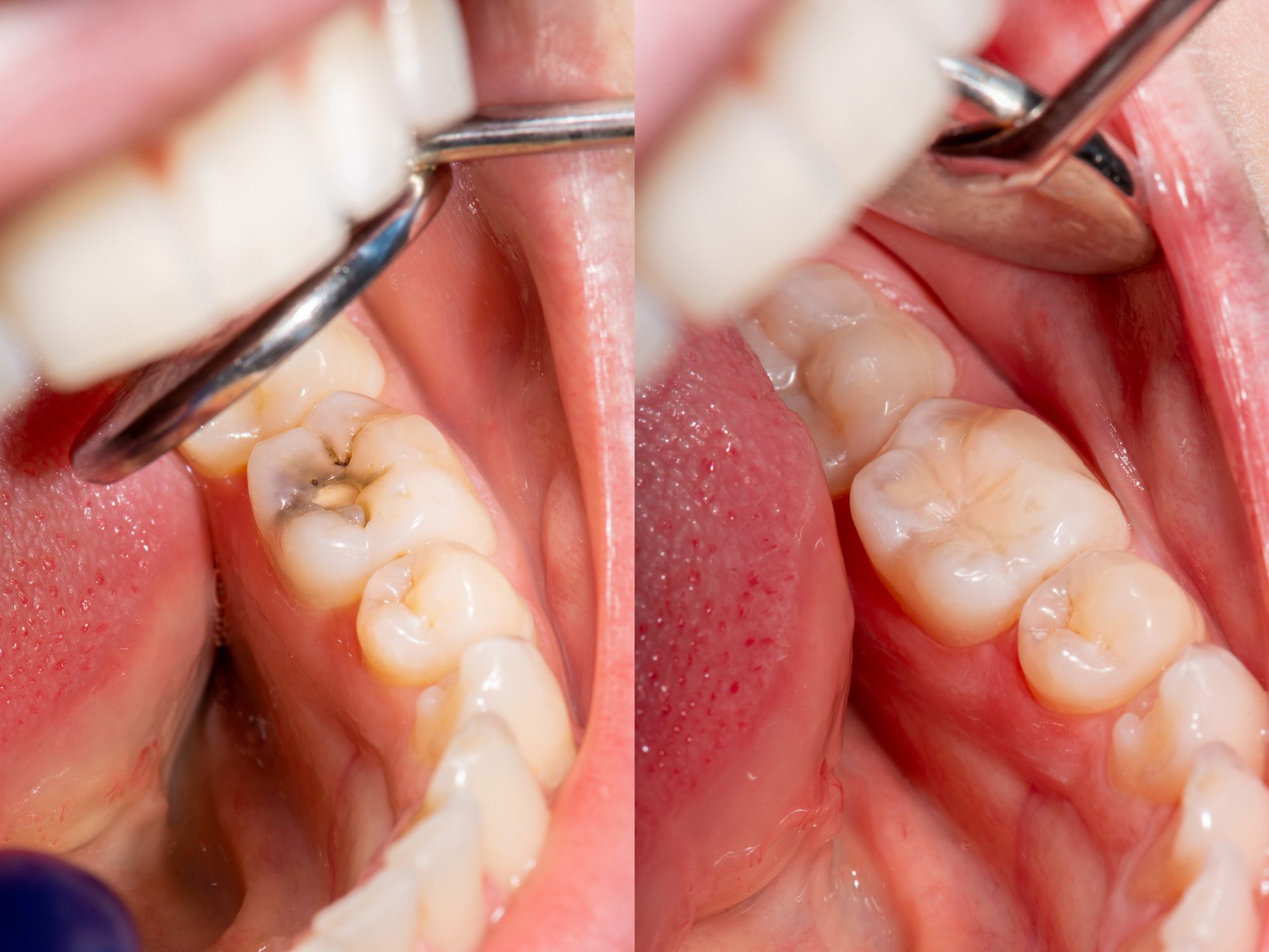 Comparing Tooth Filling Options and Costs