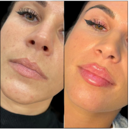 Safe and Effective Fillers in Dubai: A User’s Guide