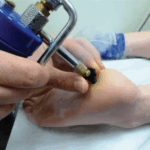 How to Safely Use Cryotherapy for Wart Removal