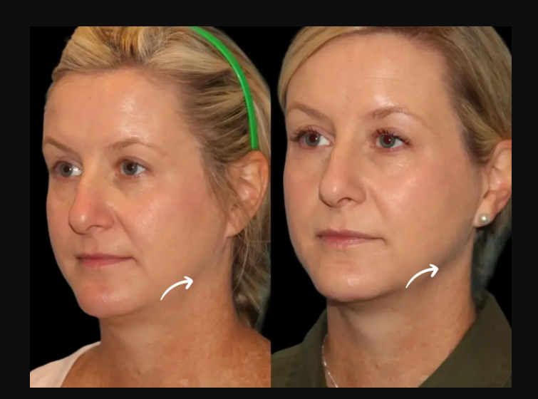 Why Dubai’s Best Plastic Surgeons Are Leaders in Facial Harmony with Sculptra Fillers