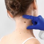 Skin Tag Removal: What to Expect Before, During, and After Treatment