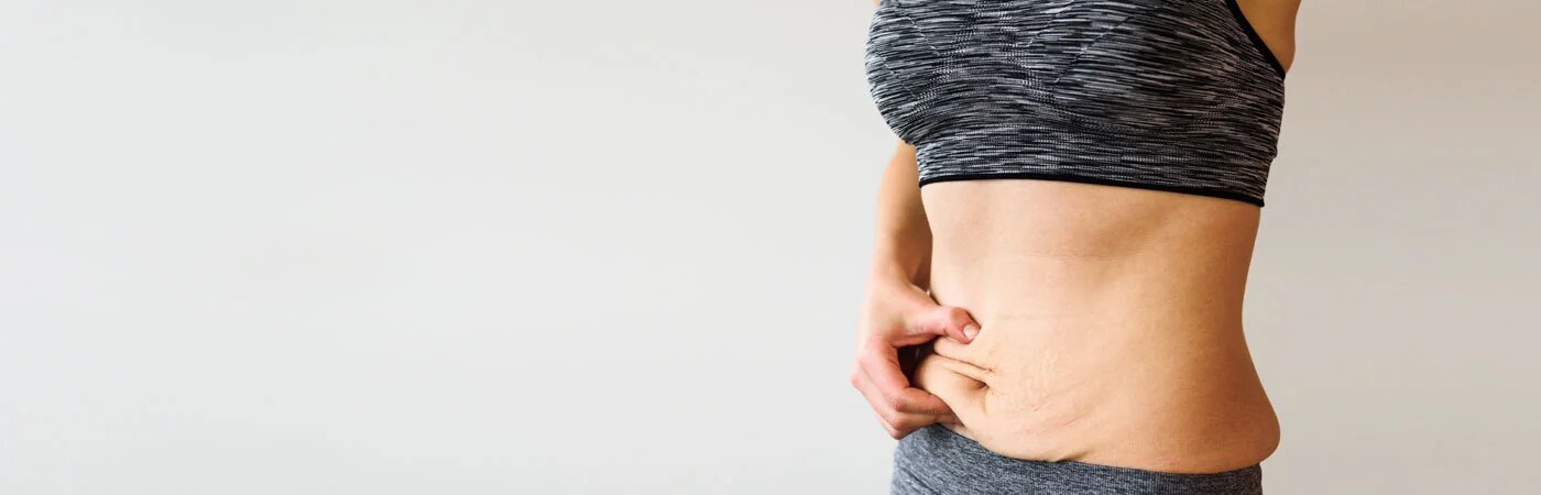 Stretch Mark Prevention: Tips You Need to Know