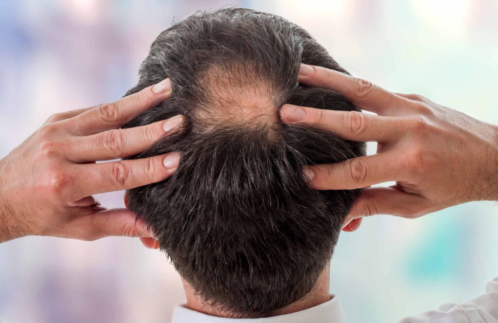 Tailored Alopecia Areata Treatment Plans