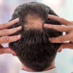 Tailored Alopecia Areata Treatment Plans
