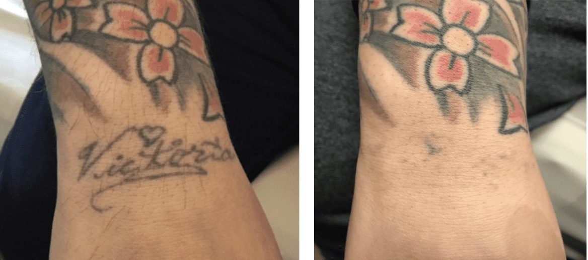 Is Your Old Tattoo Still Visible After Treatment? Here’s How PicoSure Can Help