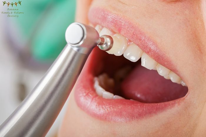 Say Goodbye to Stains: Riyadh Dental Polish