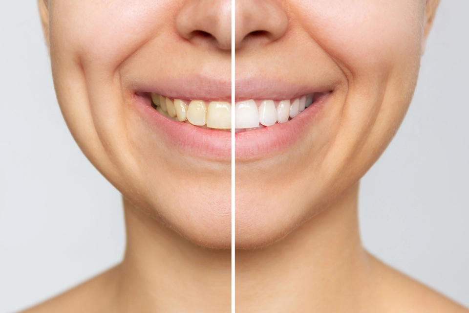 Teeth Whitening Cost by Type