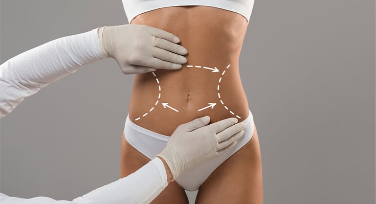 Tummy Tuck in Dubai