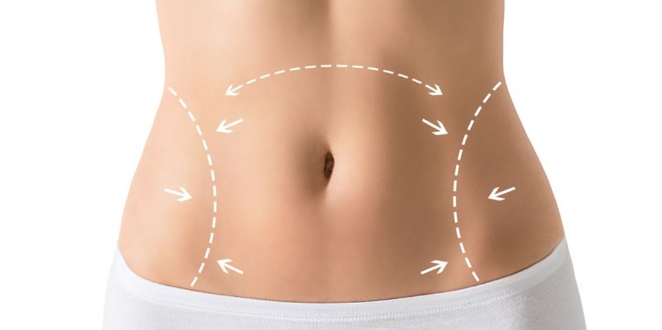 Tummy Tuck in Dubai