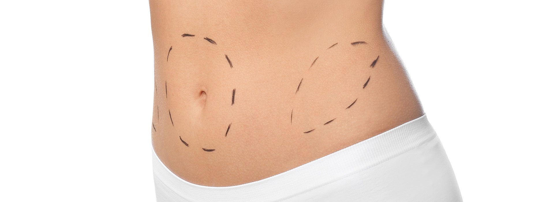 Can Men Get A Tummy Tuck In Dubai?