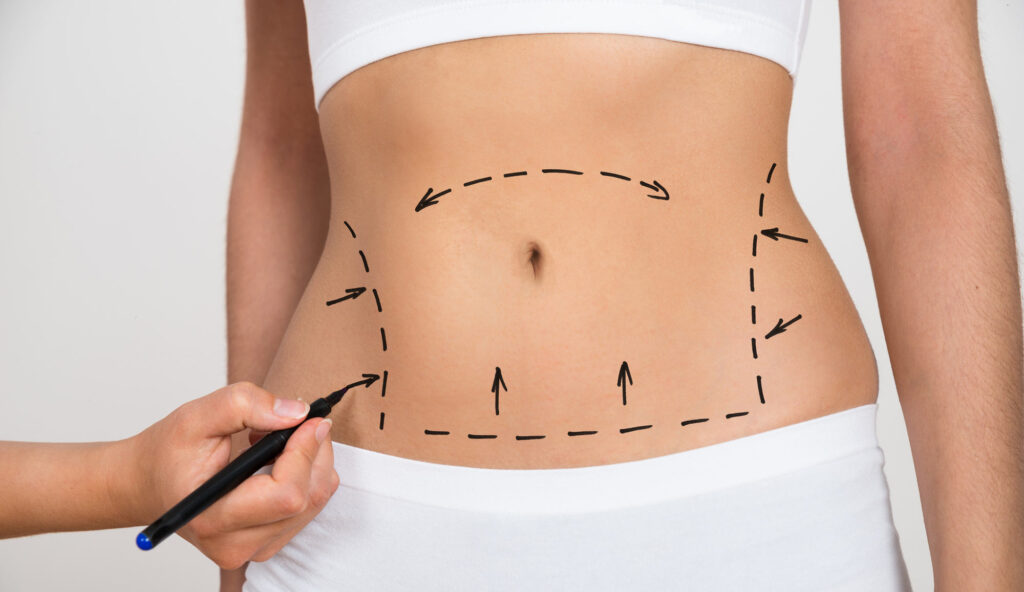Benefits of a Tummy Tuck in Dubai