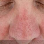 Can a Chemical Peel Help with Acne Scars and Dark Spots?