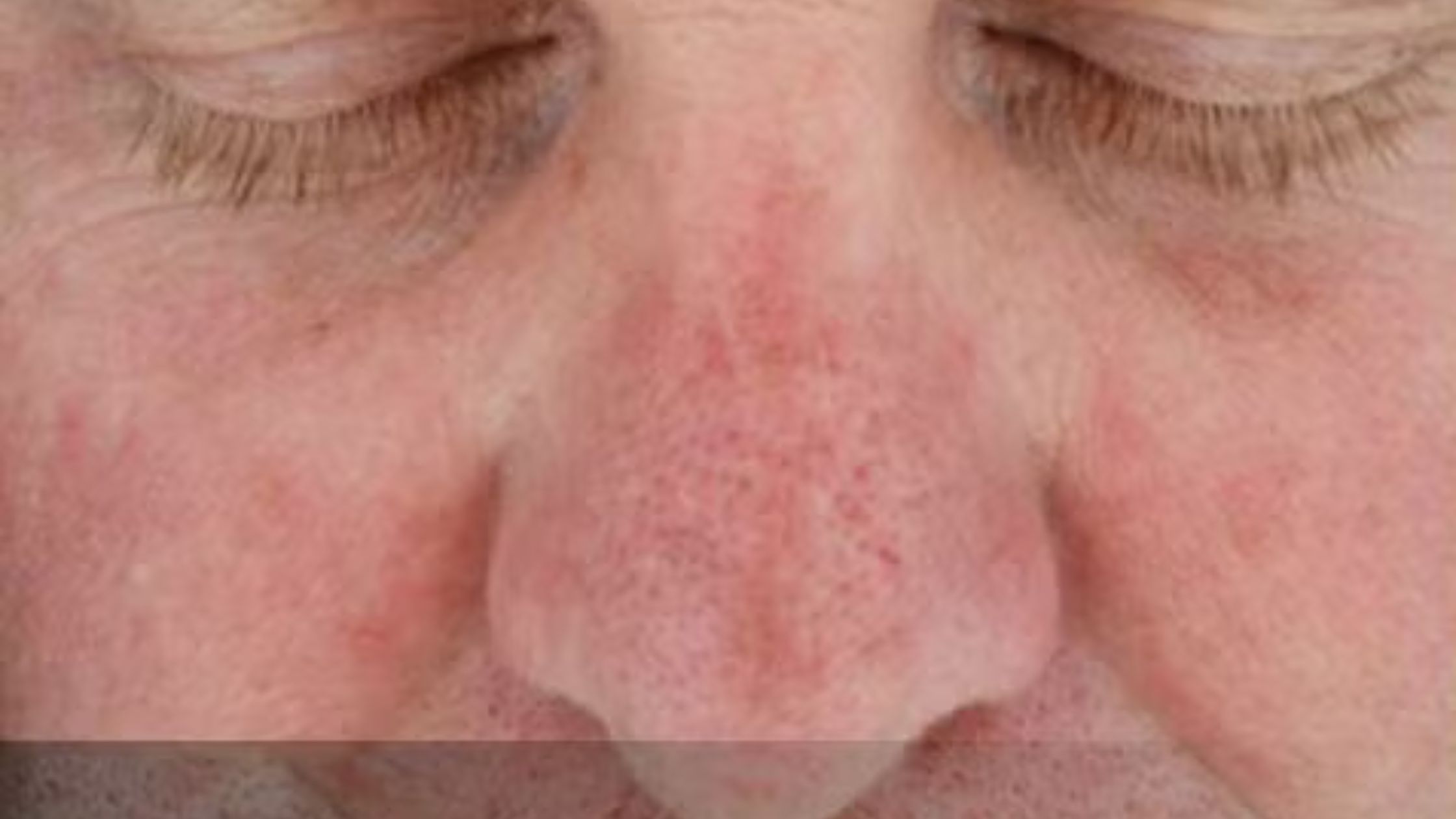 Can a Chemical Peel Help with Acne Scars and Dark Spots?
