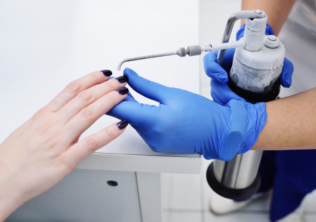 Cryotherapy for Warts: A Quick and Effective Way to Eliminate Unwanted Growths