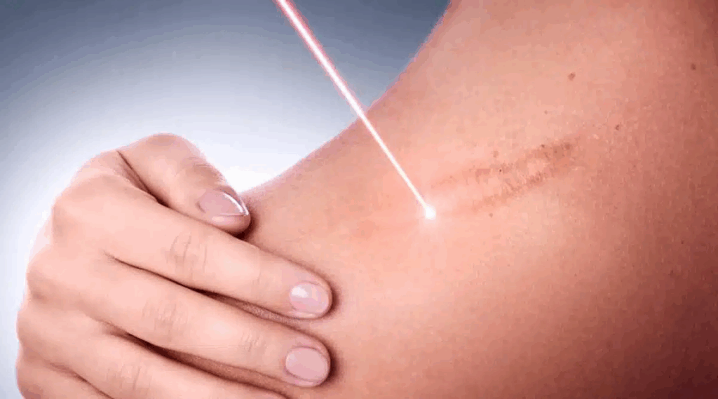What Types of Scars Can Be Treated with Laser Therapy?