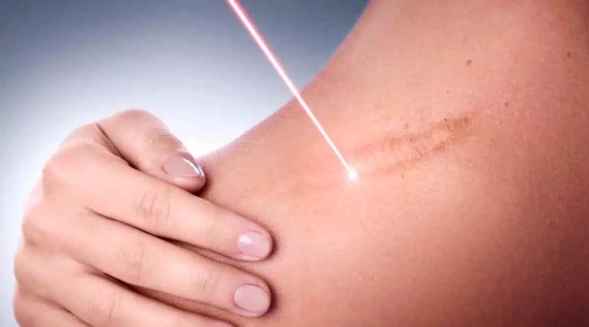 What Types of Scars Can Be Treated with Laser Therapy?
