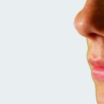 How Acne Laser Treatment Can Improve Your Skin Texture and Scarring