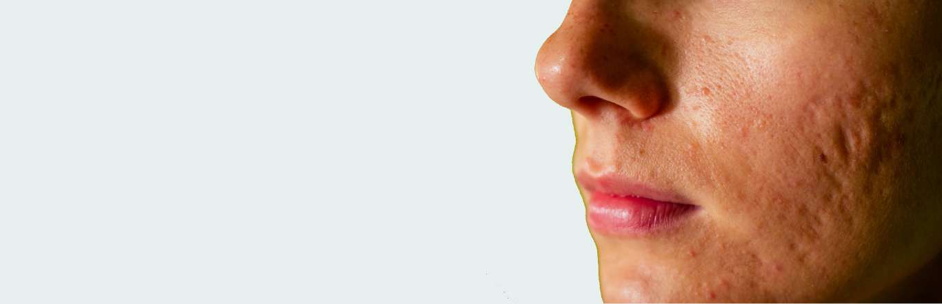 How Acne Laser Treatment Can Improve Your Skin Texture and Scarring