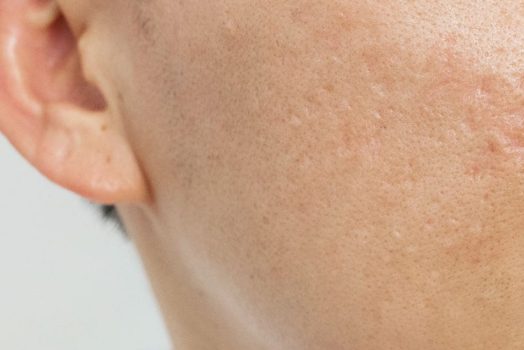 Is It Worth Going to a Dermatologist for Acne Scars?