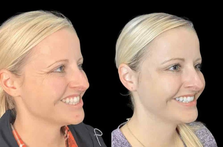 What Sets the Best Plastic Surgeon in Dubai for Botox Apart