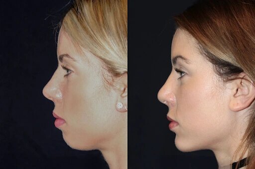 Chin Fillers Treatments in Dubai: A Quick Solution for a More Defined Profile
