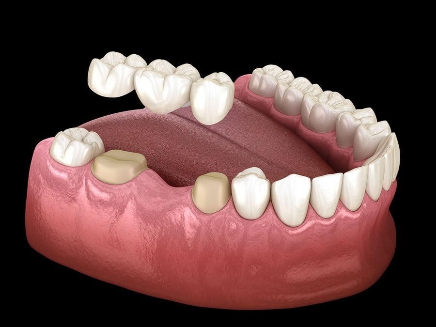 Dental Crowns and Bridges Basics