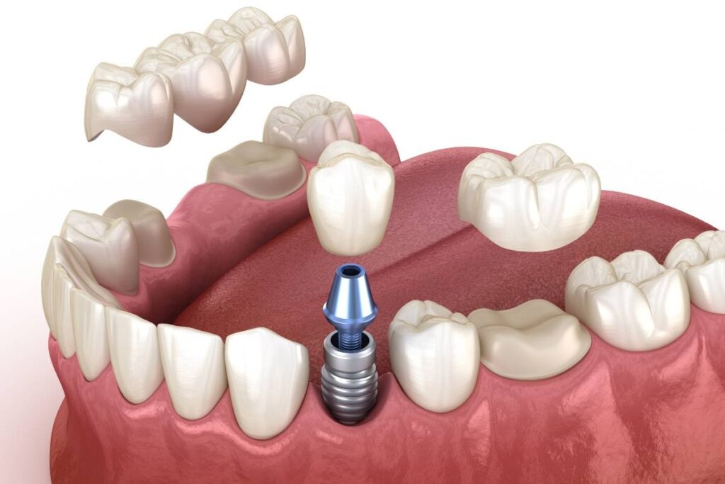 Strengthen Teeth With Crowns & Bridges