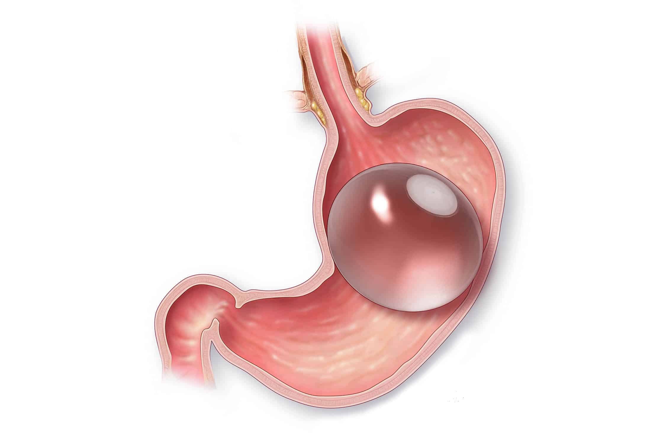 Your First Month with Gastric Balloon