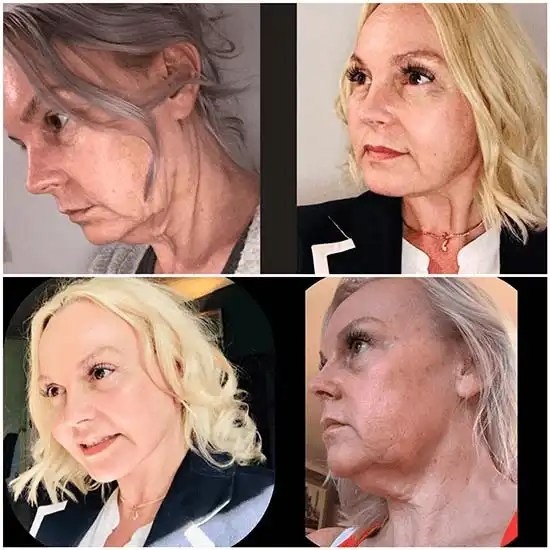Reset Your Glow with Profhilo from Best Plastic Surgeon in dubai