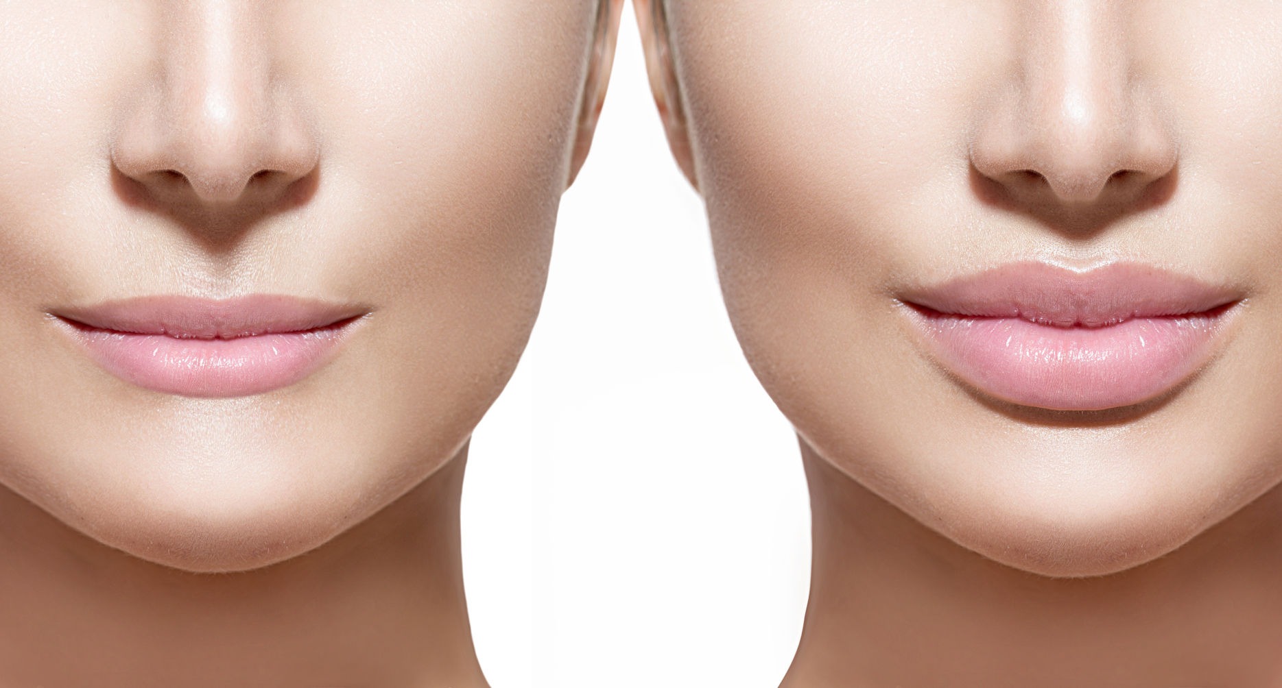Juvederm Fillers in Dubai