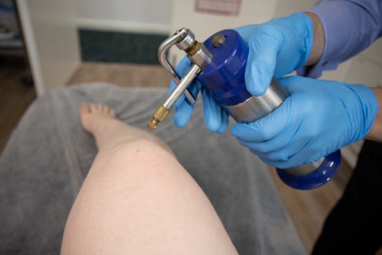 Fast Relief from Warts: Why Cryotherapy is the Best Option for You