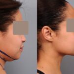 Who can get double chin liposuction?