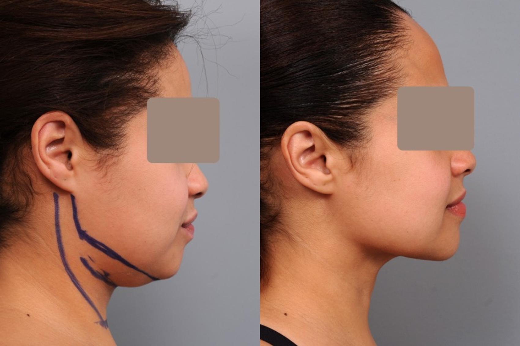 Who can get double chin liposuction?