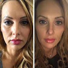 Achieve a Youthful Look at the Best Aesthetic Clinics in Dubai for Thread Lift