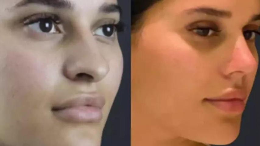 The Rise of Ethnic Rhinoplasty in Dubai: Celebrating Facial Diversity