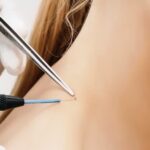 Natural Ways for Skin Wart Removal at Home