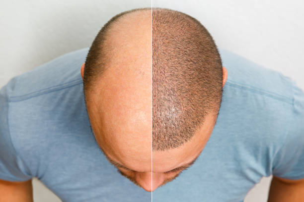 زراعة الشعر في الرياض من قبل خبراء المجال